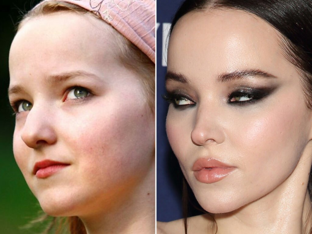 Dove Cameron Plastic Surgery before and after