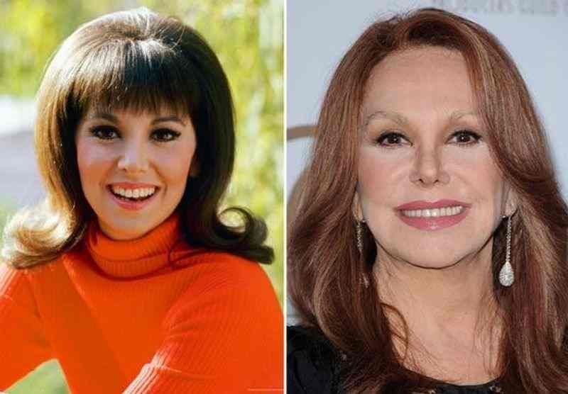 Marlo Thomas Plastic Surgery