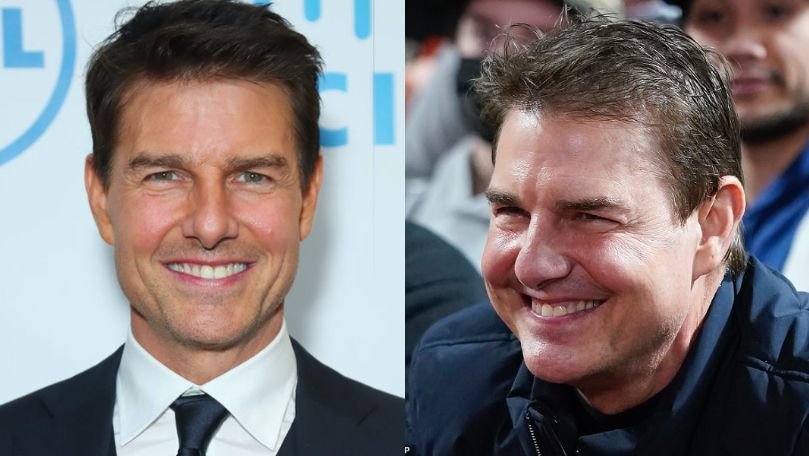 Tom Cruise Plastic Surgery