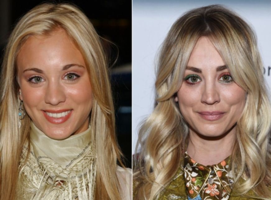 Kaley Cuoco Plastic Surgery Journey