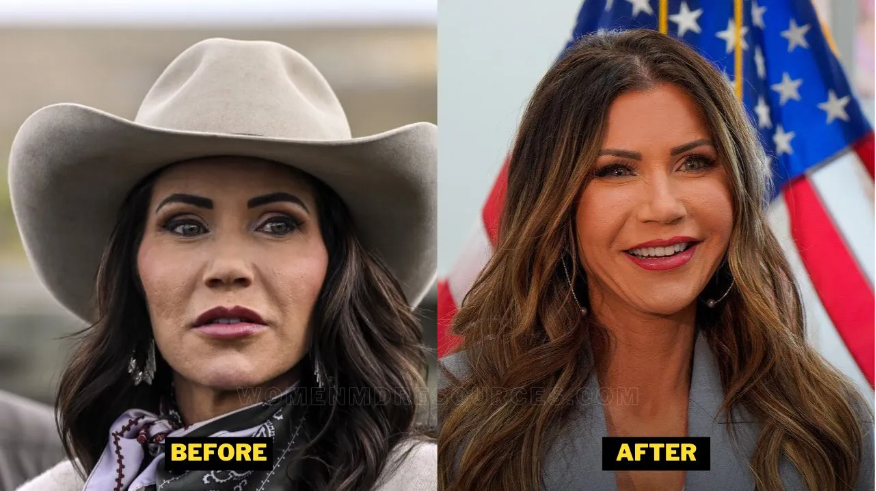 Kristi Noem plastic surgery