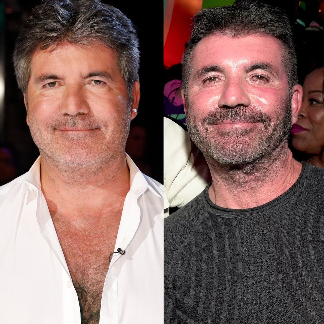 Simon Cowell plastic surgery